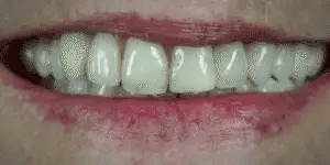 Snap-On Veneers Di NovaBright Creano Un Sorriso Naturale E Veloce Per I Denti Superiori E Inferiori