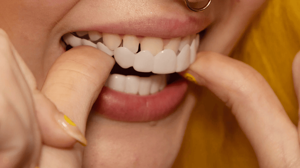 Snap-On Veneers Di NovaBright Creano Un Sorriso Naturale E Veloce Per I Denti Superiori E Inferiori
