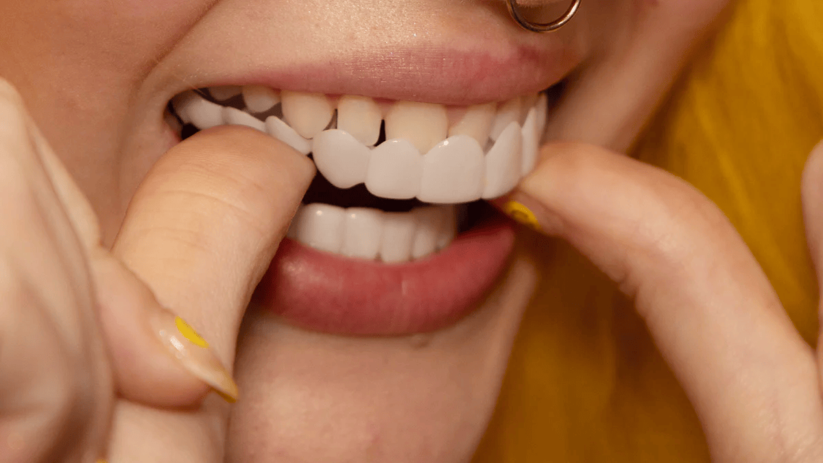 LumaGrin Veneers Rapidi per Denti Superiori e Inferiori