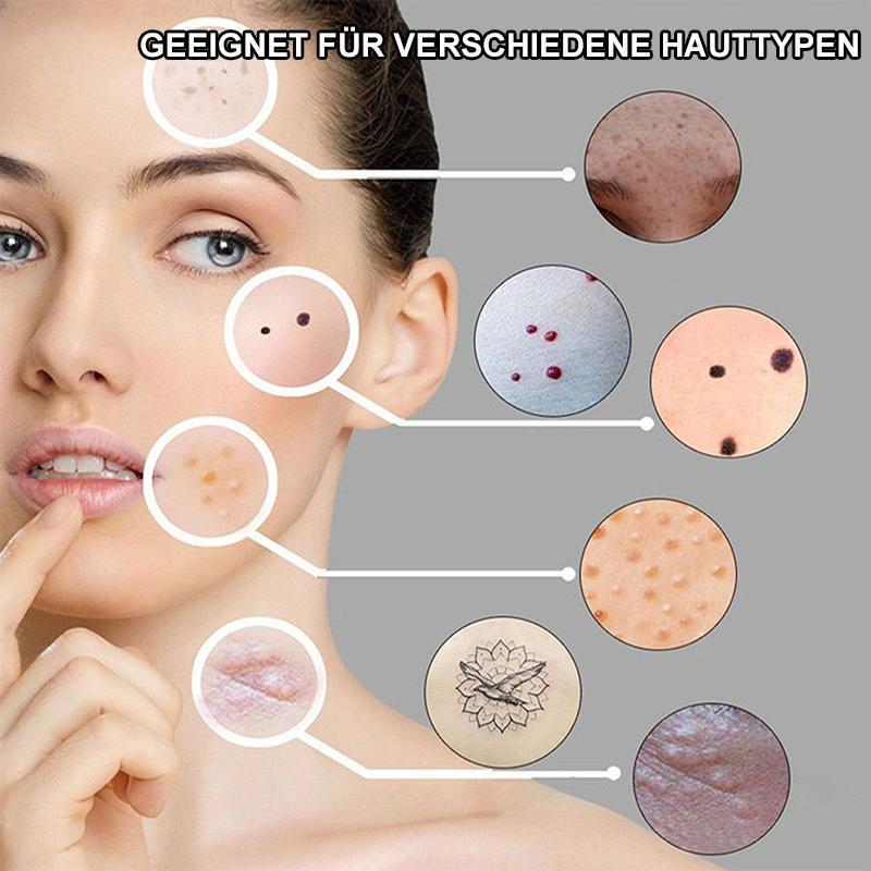 Penna per trattamento laser Blu-Ray per rimuovere l'acne indesiderata