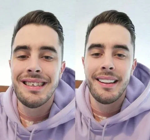Brehn | Su Smile Veneers (inclusi arcate superiore e inferiore)