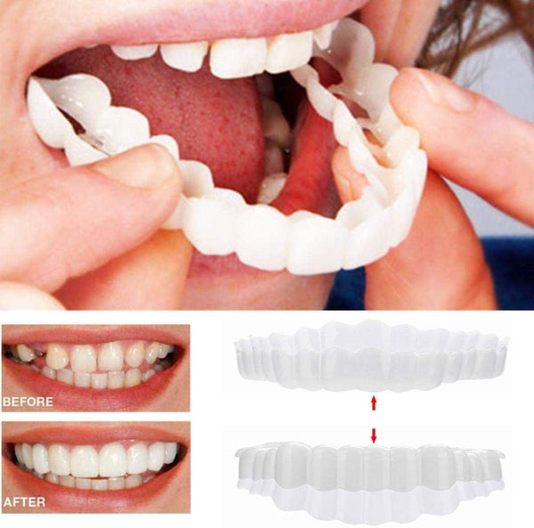 Brehn | Su Smile Veneers (inclusi arcate superiore e inferiore)
