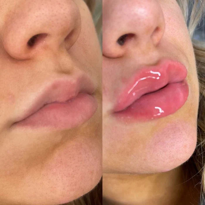 Ottieni labbra più piene rapidamente usando il siero volumizzante per labbra LumaGlow
