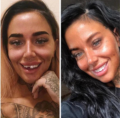 LumaGrin Veneers Rapidi per Denti Superiori e Inferiori