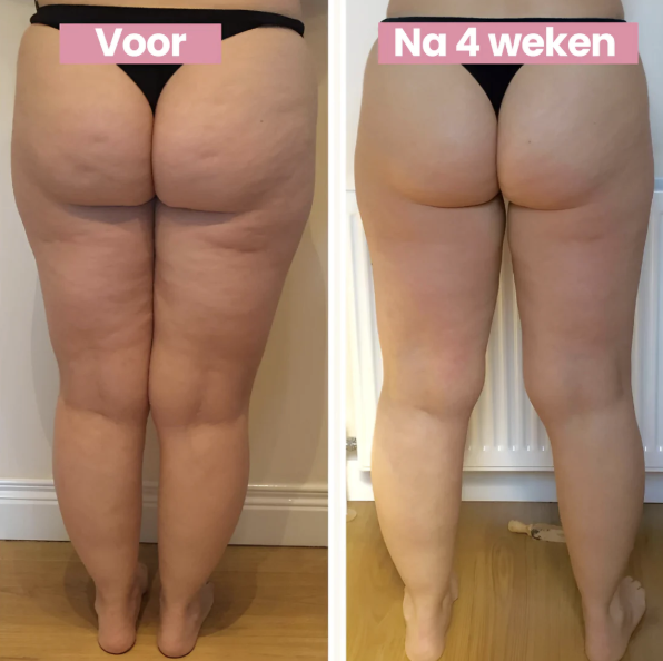 SmoothLift | Trattamento Anti-Cellulite e Rassodamento della Pelle