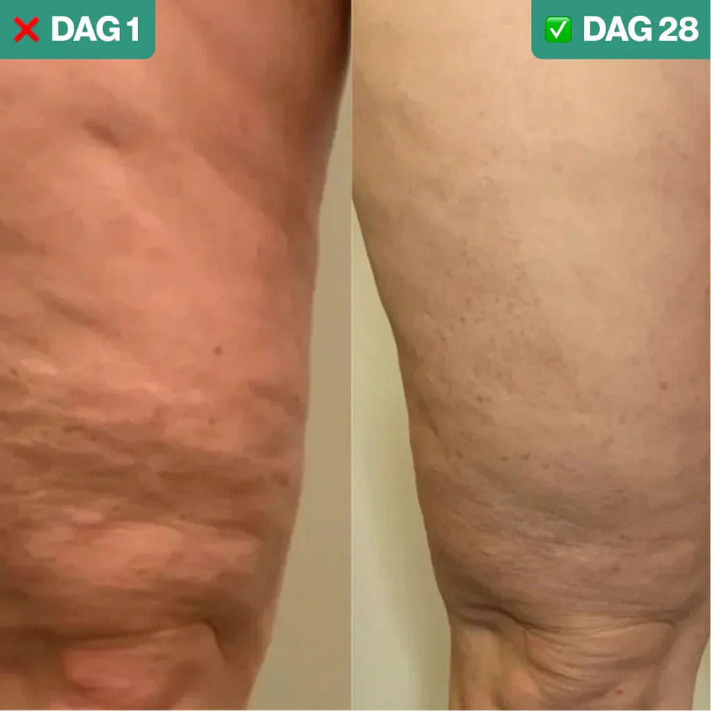 SmoothLift | Trattamento Anti-Cellulite e Rassodamento della Pelle