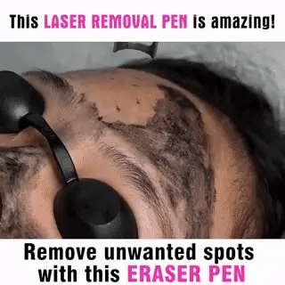 Penna Laser Compatta AstraGlow per Rimozione di Tatuaggi, Nei e Lentiggini