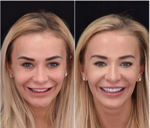 LumaGrin Veneers Rapidi per Denti Superiori e Inferiori