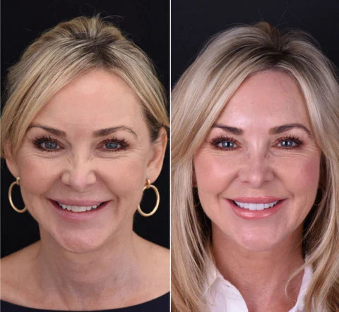 LumaGrin Veneers Rapidi per Denti Superiori e Inferiori