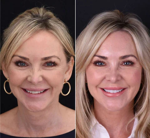 Snap-On Veneers Di NovaBright Creano Un Sorriso Naturale E Veloce Per I Denti Superiori E Inferiori