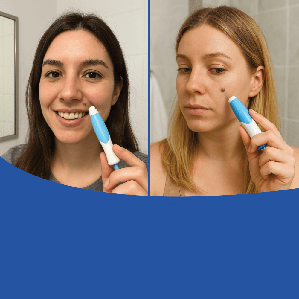 LuxuraCare Rimuovi Verruche Professionale | Soluzione efficace per la rimozione delicata delle verruche peduncolate