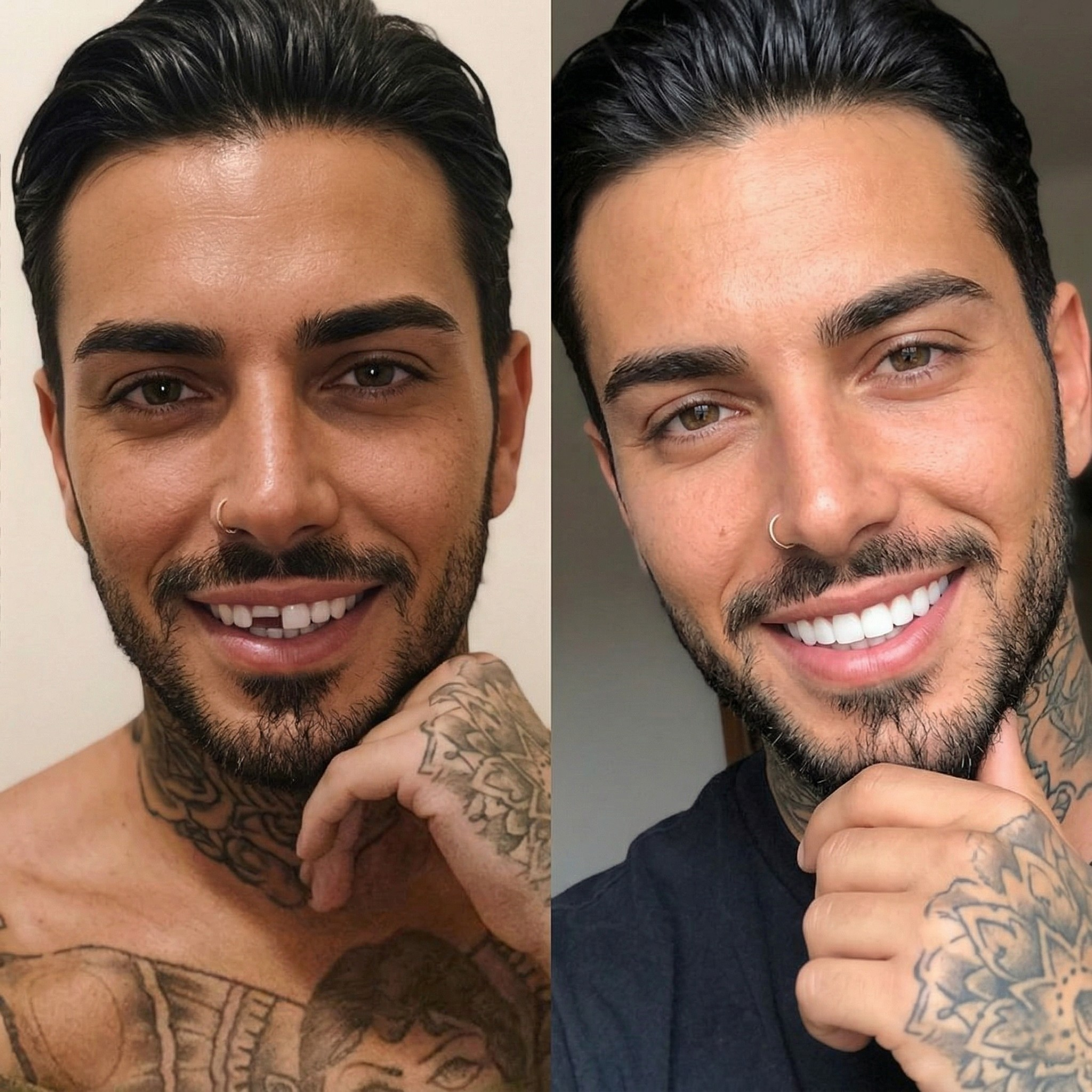 Faccette Dentali Istantanee per Arcata Superiore e Inferiore Sorriso Naturale
