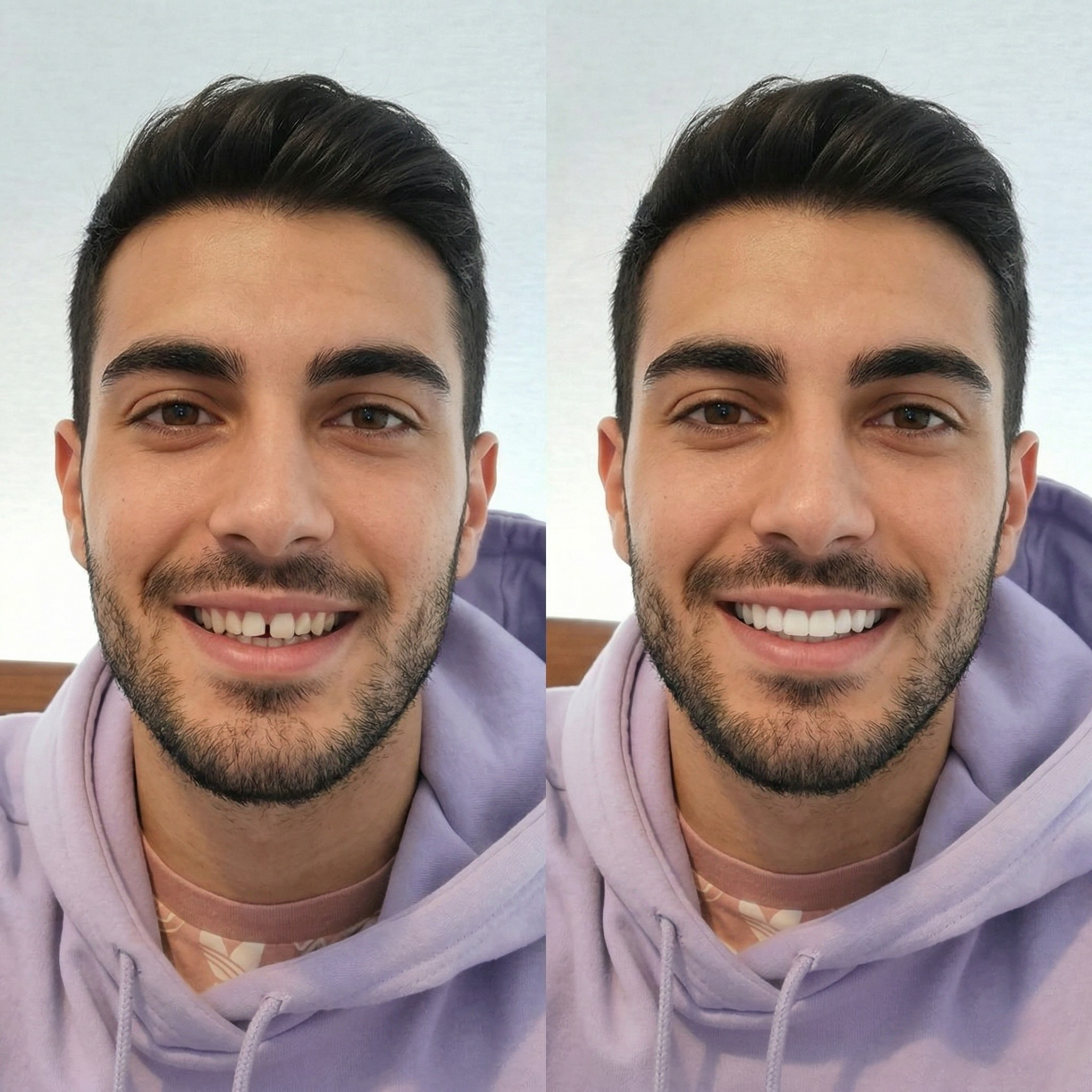 Faccette Dentali Istantanee per Arcata Superiore e Inferiore Sorriso Naturale
