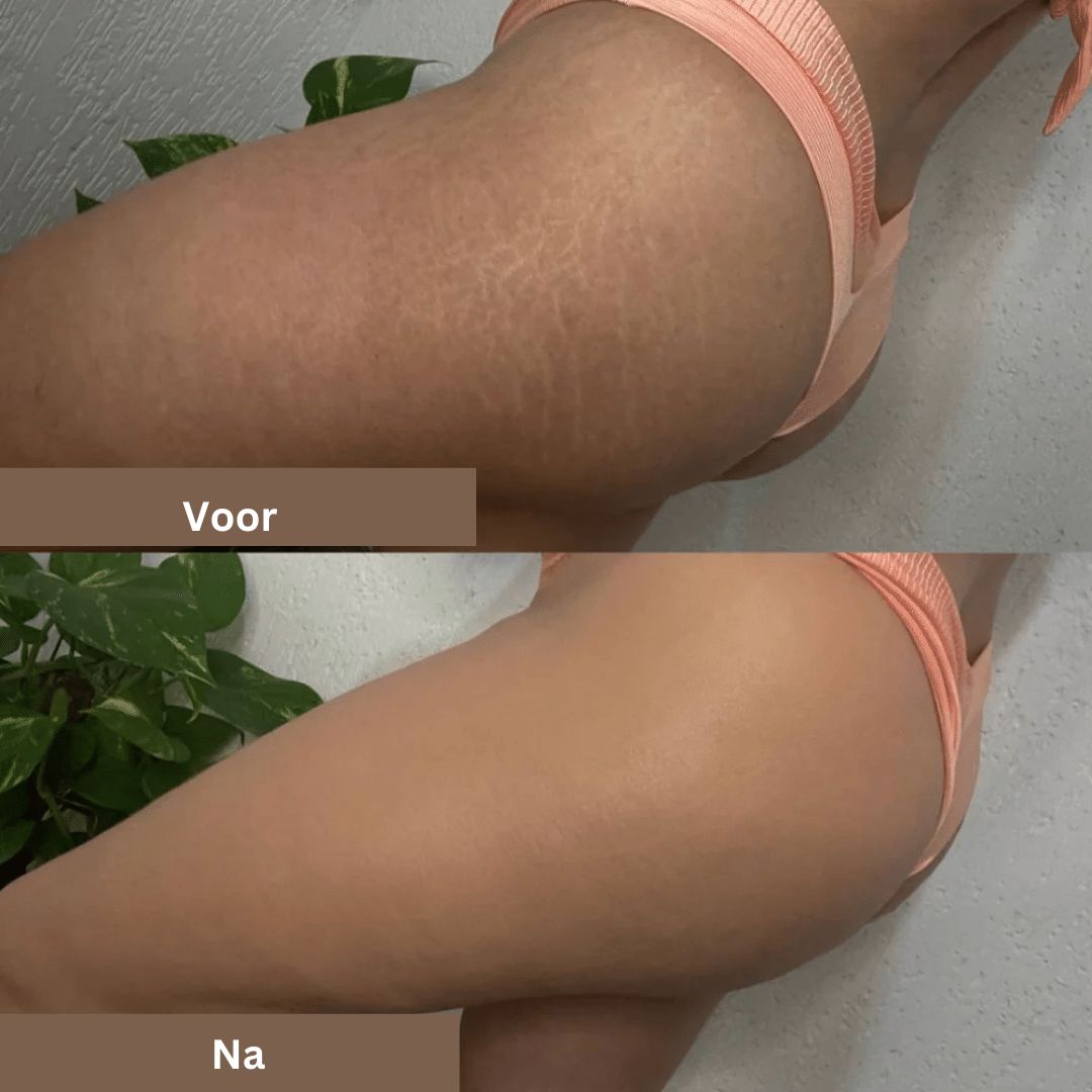 SmoothTone skincare | Per coprire cicatrici, vene, acne e macchie solari