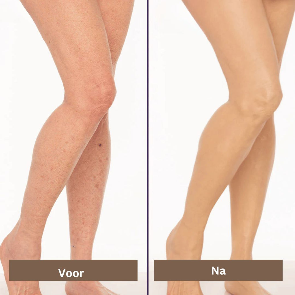 SmoothTone skincare | Per coprire cicatrici, vene, acne e macchie solari