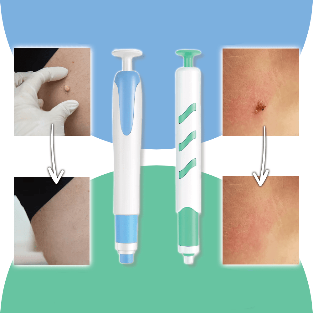 LuxuraCare Rimuovi Verruche Professionale | Soluzione efficace per la rimozione delicata delle verruche peduncolate