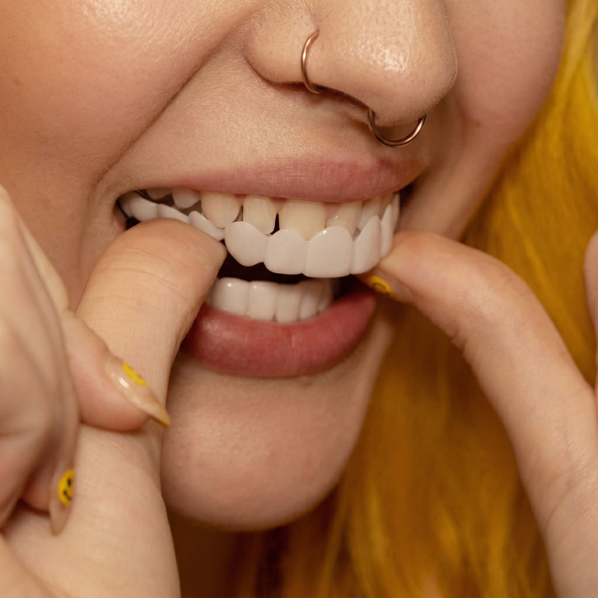 Faccette Dentali Istantanee per Arcata Superiore e Inferiore Sorriso Naturale